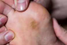 Penyebab dan Cara Mengatasi Mata Ikan atau Penebalan Kulit di Kaki dan Tangan