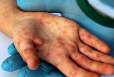 Ribuan Warga Indonesia Terpapar Flu Singapura