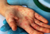 Ribuan Warga Indonesia Terpapar Flu Singapura